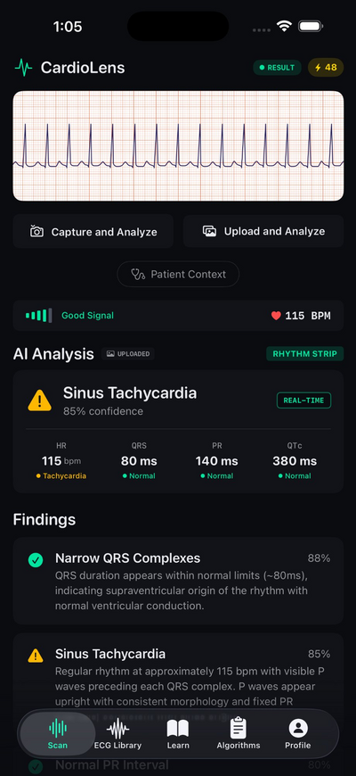 CardioLens AI Scan Results — instant rhythm identification with confidence and clinical findings